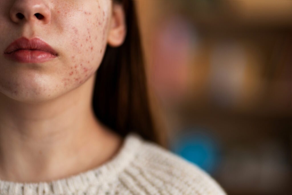 Cystic Acne