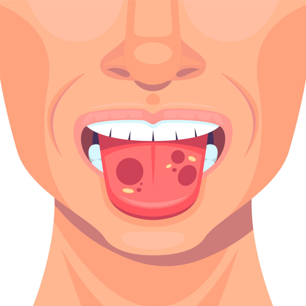 geographic tongue